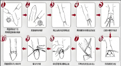北京泰悦医疗暑期护航｜18 岁割包皮，无拘无束迎成年新旅程！